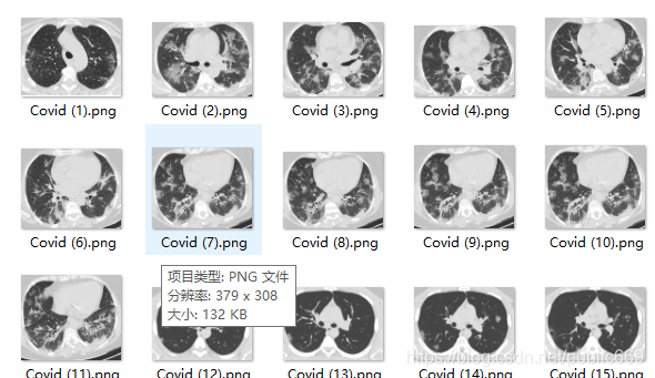 新冠肺炎（Covid-19）检测系统_数据集_03